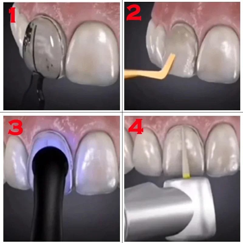 Stampi Dentali per Faccette in - Teeth Whitening Moulds recensione e prezzo